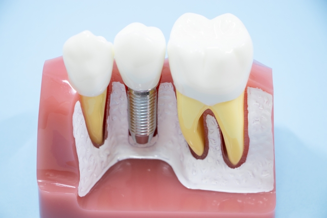 インプラントってどんな治療？ブリッジ・入れ歯との違いをやさしく解説