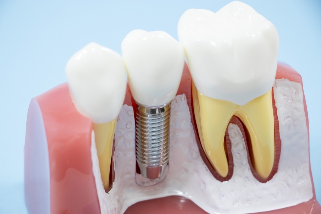 歯周病の治療はインプラントだけではない―残せる歯を守る選択肢とは